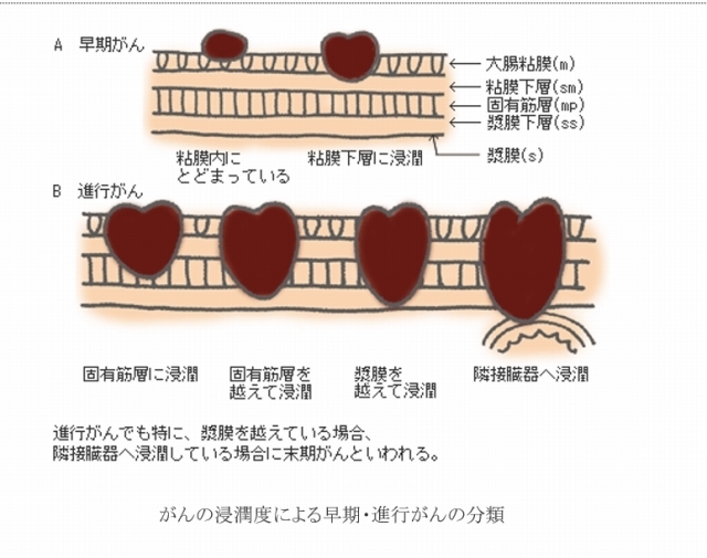 s病理組織.jpg
